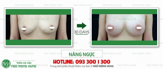 Cẩm nang làm đẹp: Nâng ngực nội soi hết bao nhiêu tiền ở đâu tại tphcm Nang-nguc-noi-soi-3